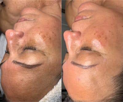 Dermaplane Before & After Gallery - Patient 100367 - Image 1