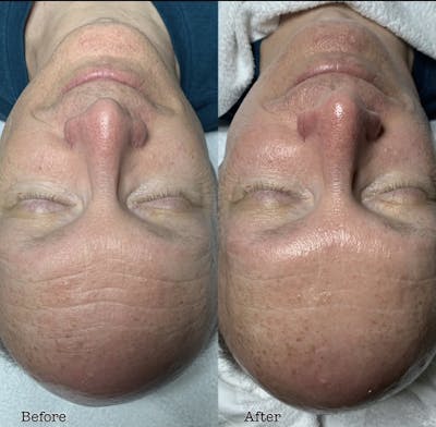 Dermasweep Before & After Gallery - Patient 299920 - Image 1