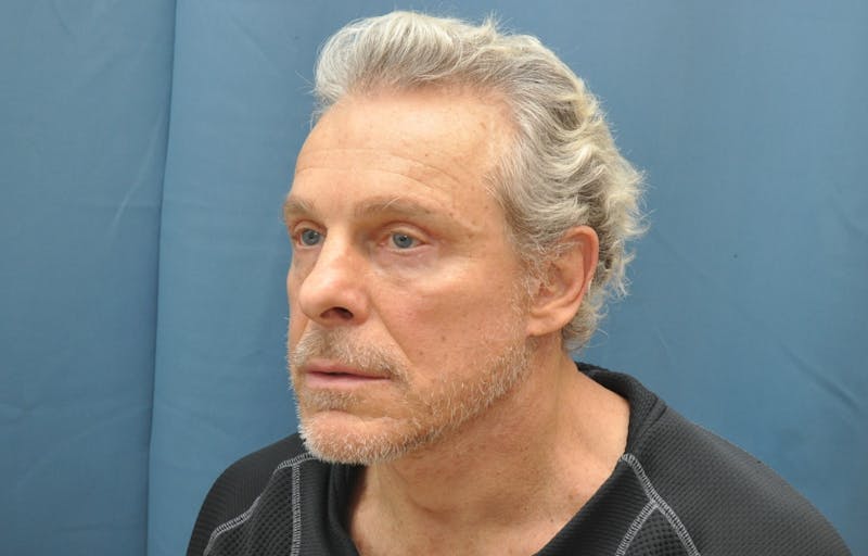 Facelift Before & After Gallery - Patient 161677 - Image 4