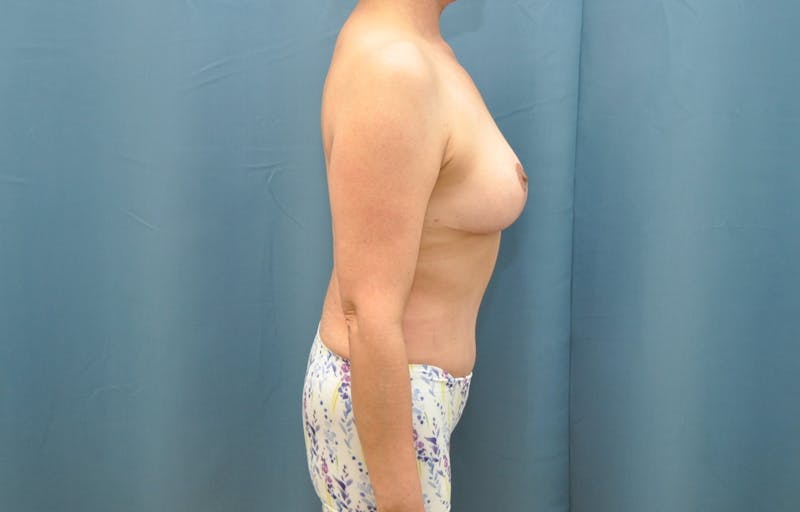 Breast Lift Before & After Gallery - Patient 223224 - Image 4