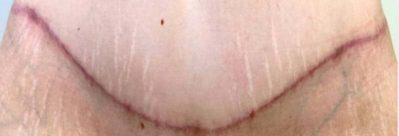 RF Microneedling Before & After Gallery - Patient 120233 - Image 1