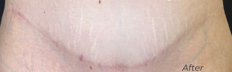 RF Microneedling Before & After Gallery - Patient 120233 - Image 2