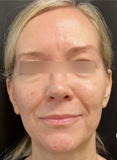 RF Microneedling Before & After Gallery - Patient 359509 - Image 1