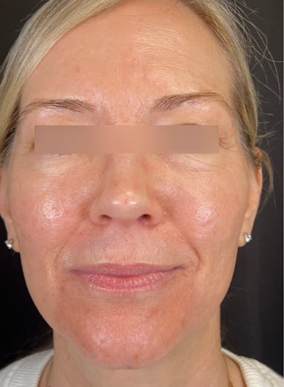 RF Microneedling Before & After Gallery - Patient 359509 - Image 2