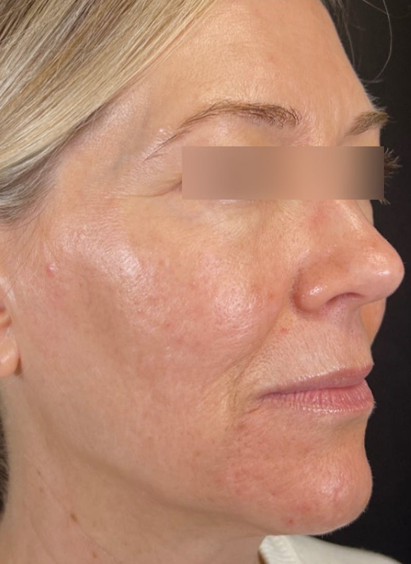 RF Microneedling Before & After Gallery - Patient 359509 - Image 3