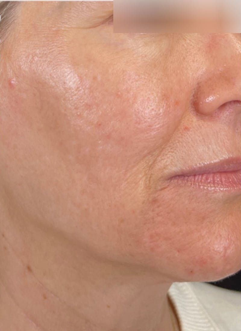 RF Microneedling Before & After Gallery - Patient 359509 - Image 4