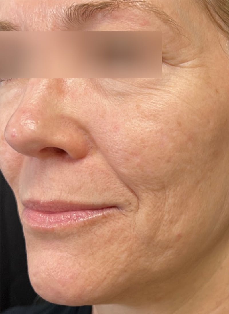 RF Microneedling Before & After Gallery - Patient 359509 - Image 5