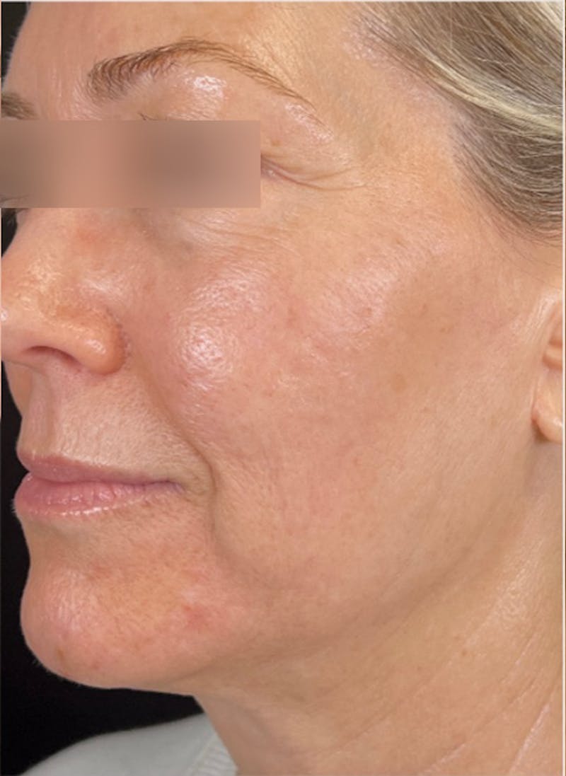 RF Microneedling Before & After Gallery - Patient 359509 - Image 6