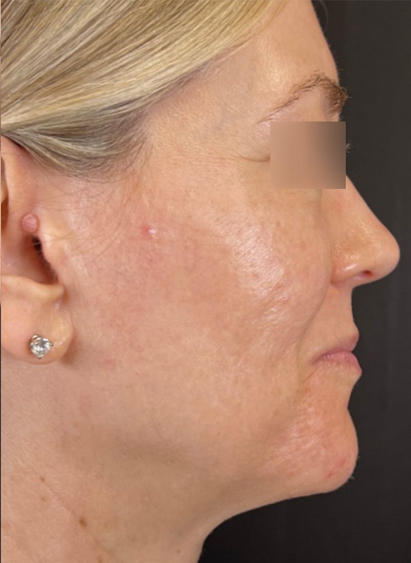 RF Microneedling Before & After Gallery - Patient 359509 - Image 7