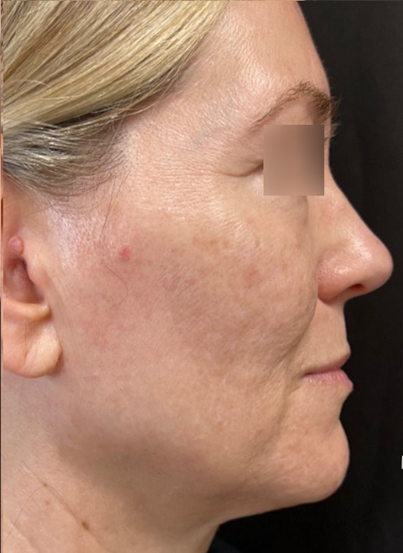 RF Microneedling Before & After Gallery - Patient 359509 - Image 8