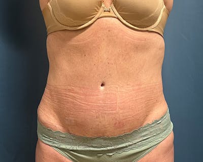 Emsculpt Before & After Gallery - Patient 432222 - Image 1