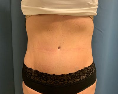 Emsculpt Before & After Gallery - Patient 432222 - Image 2
