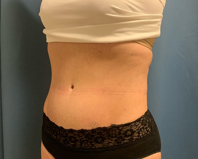 Emsculpt Before & After Gallery - Patient 432222 - Image 4