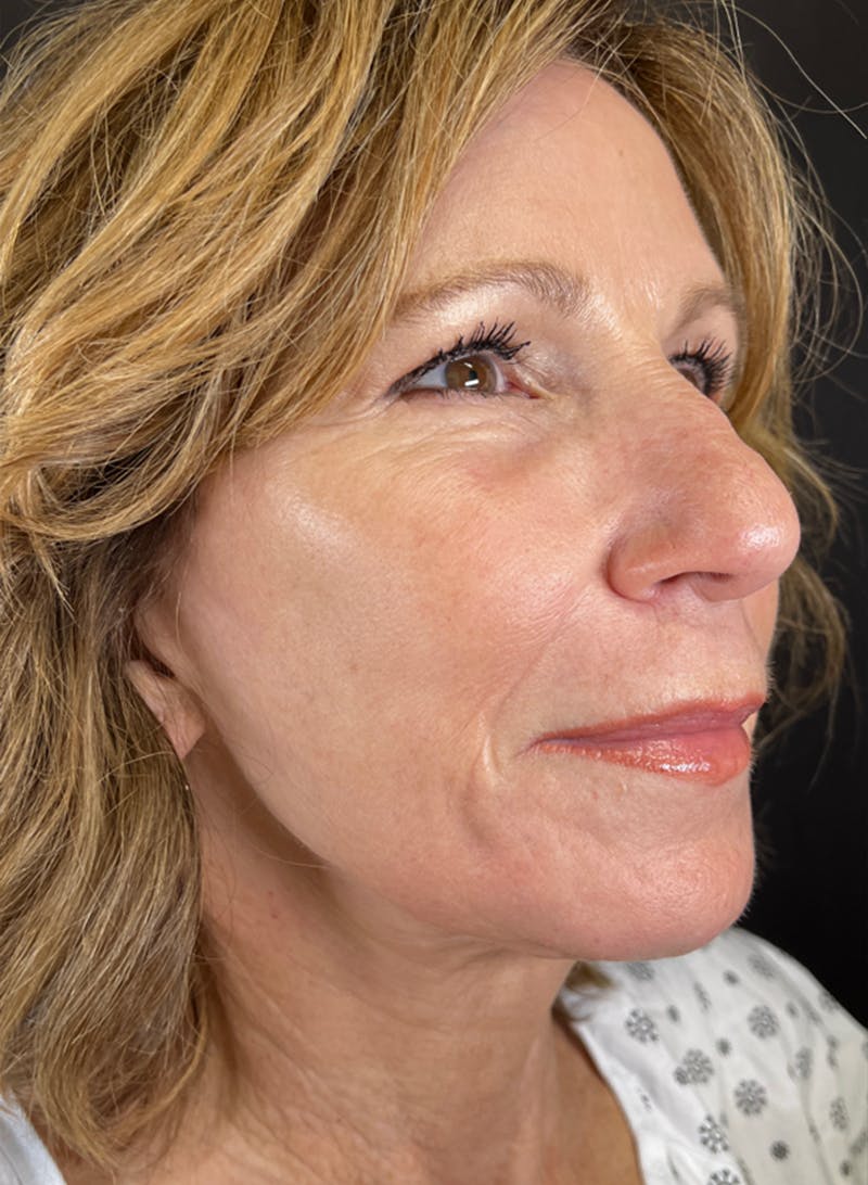 BBL/Moxi Before & After Gallery - Patient 126179 - Image 4