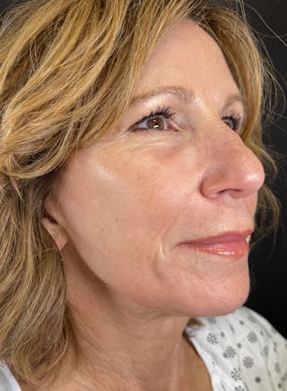 BBL/Moxi Before & After Gallery - Patient 126179 - Image 4