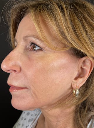 BBL/Moxi Before & After Gallery - Patient 126179 - Image 6