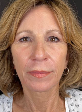 BBL/Moxi Before & After Gallery - Patient 126179 - Image 2