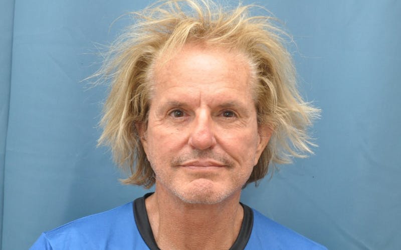 Blepharoplasty Before & After Gallery - Patient 346033 - Image 2