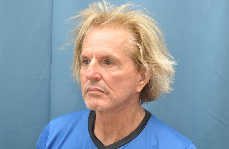 Blepharoplasty Before & After Gallery - Patient 346033 - Image 6