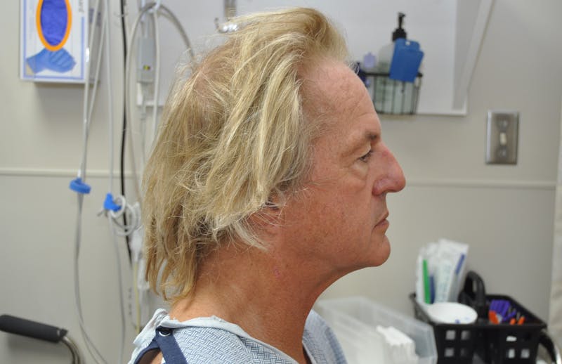 Facelift Before & After Gallery - Patient 142641 - Image 3
