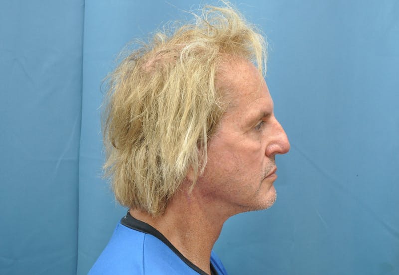 Facelift Before & After Gallery - Patient 142641 - Image 4
