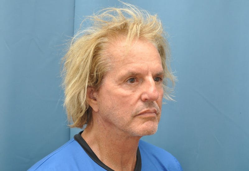 Blepharoplasty Before & After Gallery - Patient 346033 - Image 4