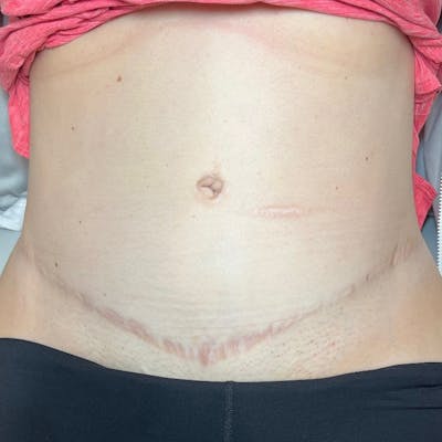 BBL/Moxi Before & After Gallery - Patient 417743 - Image 2