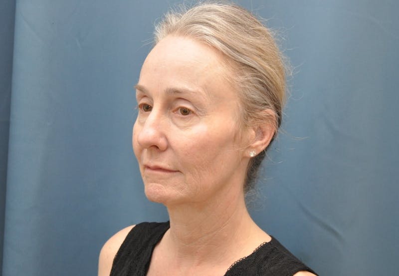 Facelift Before & After Gallery - Patient 225927 - Image 3