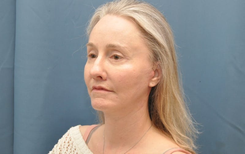 Facelift Before & After Gallery - Patient 225927 - Image 4