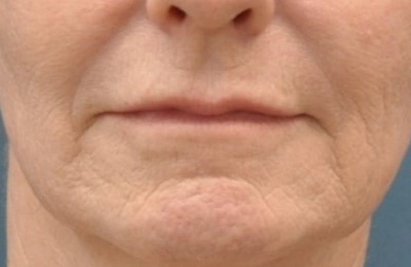 Facelift Before & After Gallery - Patient 225927 - Image 5