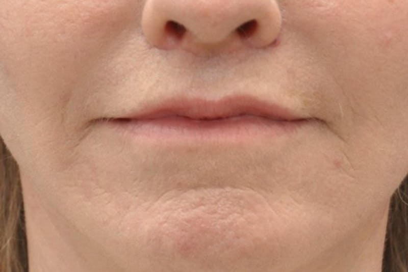 Facelift Before & After Gallery - Patient 225927 - Image 6