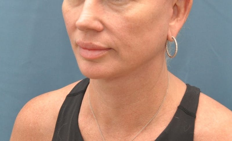 Necklift Before & After Gallery - Patient 291222 - Image 4