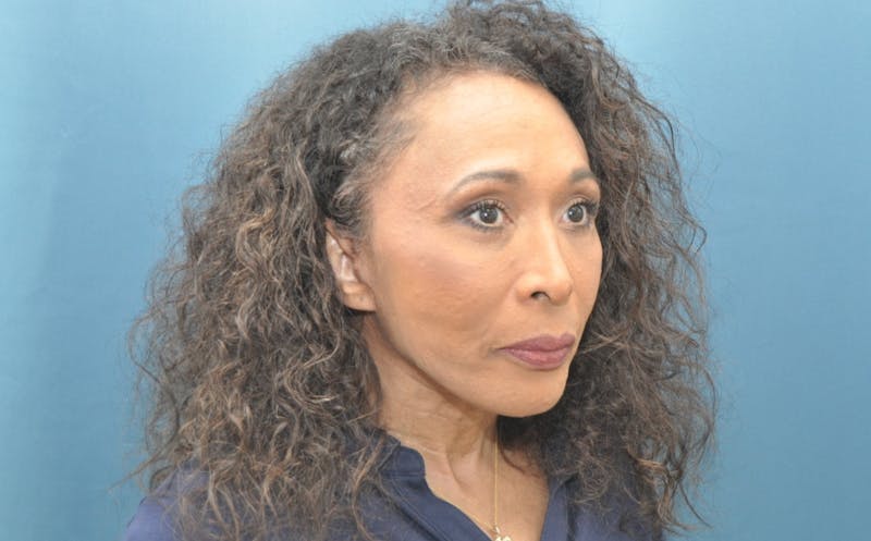 Blepharoplasty Before & After Gallery - Patient 100496 - Image 4