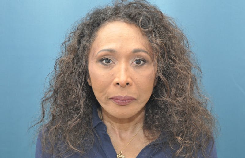 Blepharoplasty Before & After Gallery - Patient 100496 - Image 2