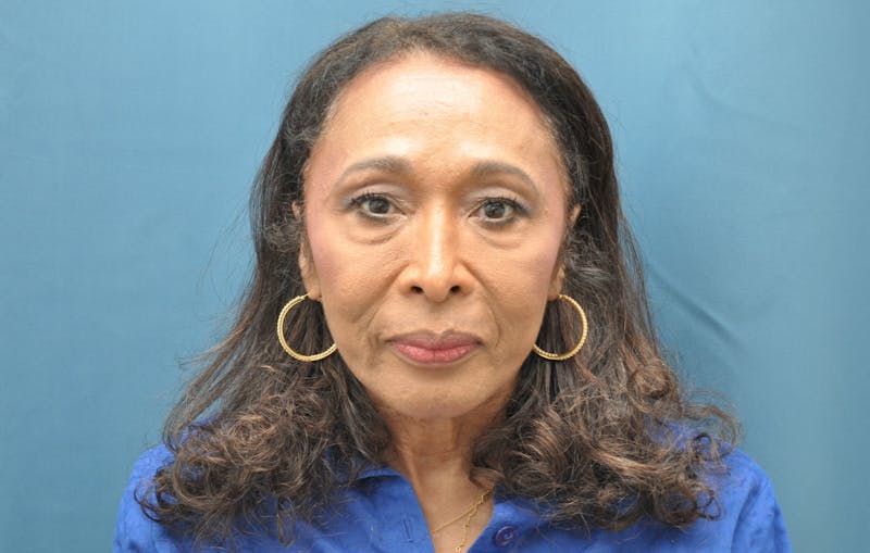 Blepharoplasty Before & After Gallery - Patient 100496 - Image 1