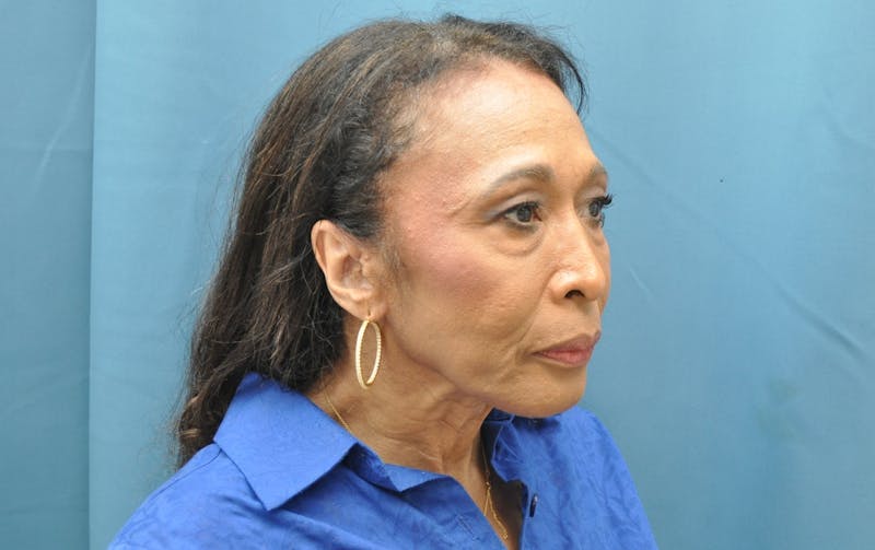 Blepharoplasty Before & After Gallery - Patient 100496 - Image 3