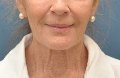 Facelift Before & After Gallery - Patient 205925 - Image 1
