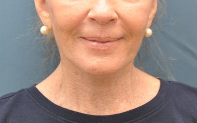 Facelift Before & After Gallery - Patient 205925 - Image 2
