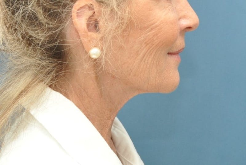 Facelift Before & After Gallery - Patient 205925 - Image 5
