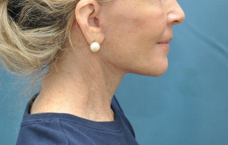 Facelift Before & After Gallery - Patient 205925 - Image 6