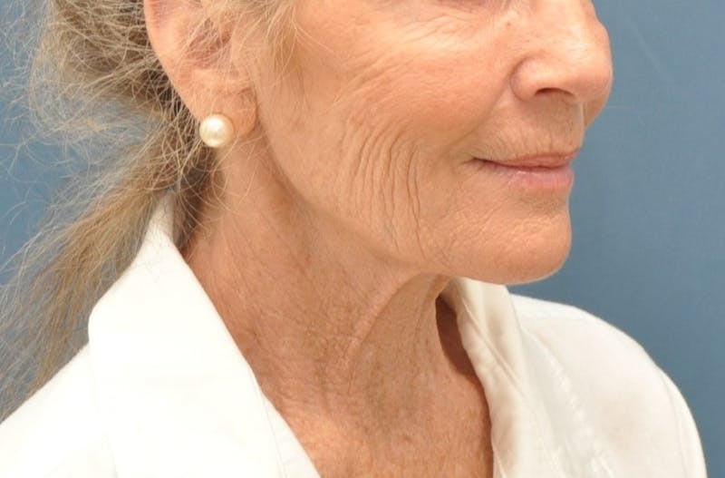 Facelift Before & After Gallery - Patient 205925 - Image 3