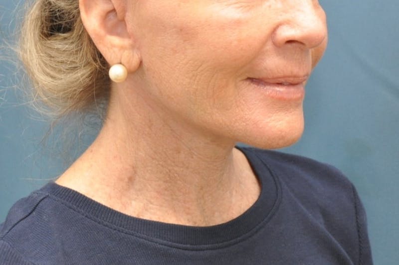 Facelift Before & After Gallery - Patient 205925 - Image 4