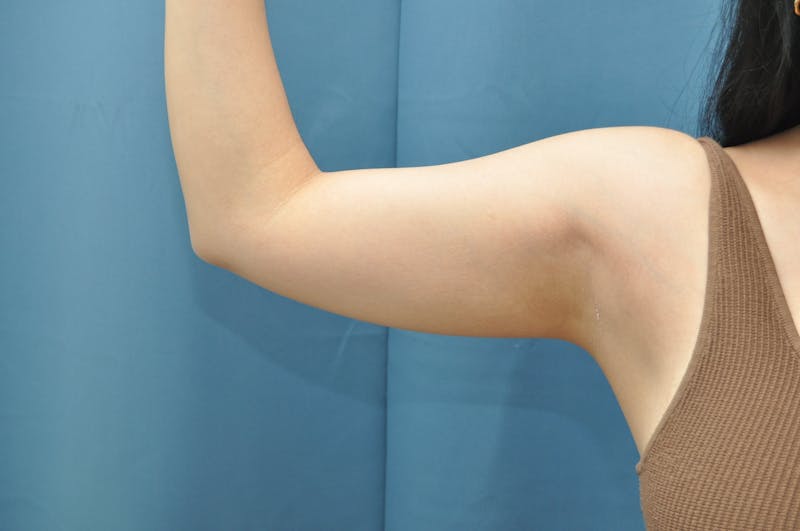 Liposuction Before & After Gallery - Patient 297012 - Image 1