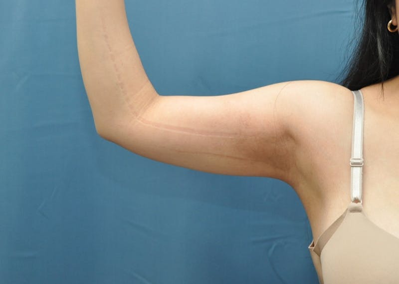 Liposuction Before & After Gallery - Patient 297012 - Image 2