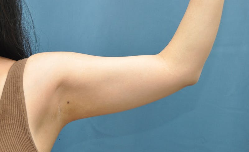 Liposuction Before & After Gallery - Patient 297012 - Image 3