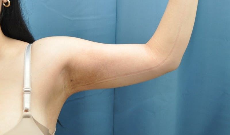 Liposuction Before & After Gallery - Patient 297012 - Image 4