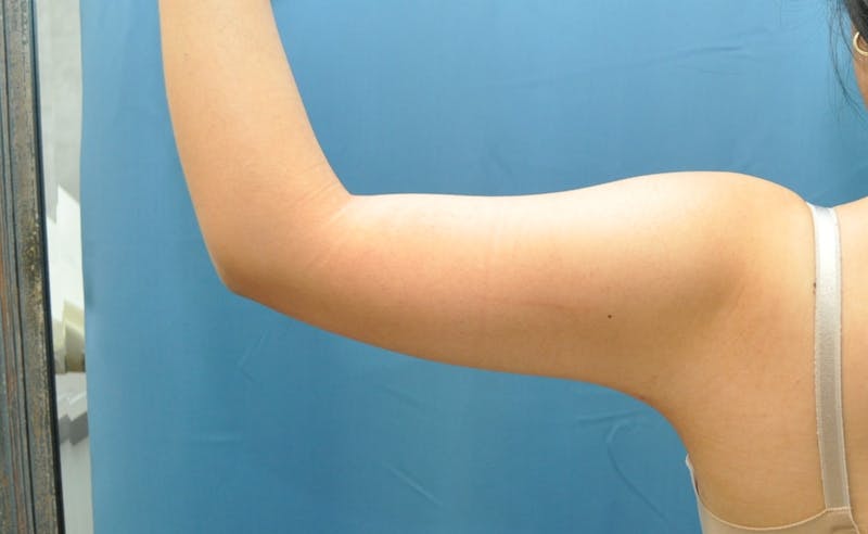 Liposuction Before & After Gallery - Patient 297012 - Image 6