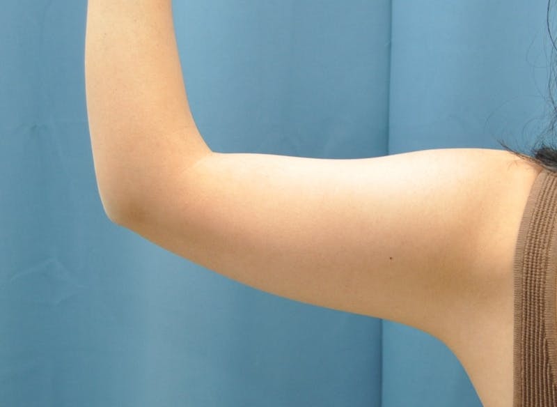 Liposuction Before & After Gallery - Patient 297012 - Image 5