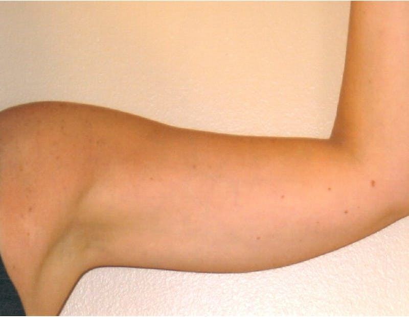 Liposuction Before & After Gallery - Patient 252425 - Image 3