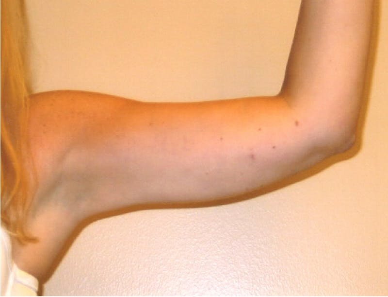Liposuction Before & After Gallery - Patient 252425 - Image 4